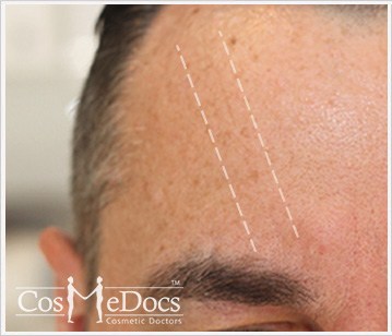 Dermal Filler Treatment forehead Before