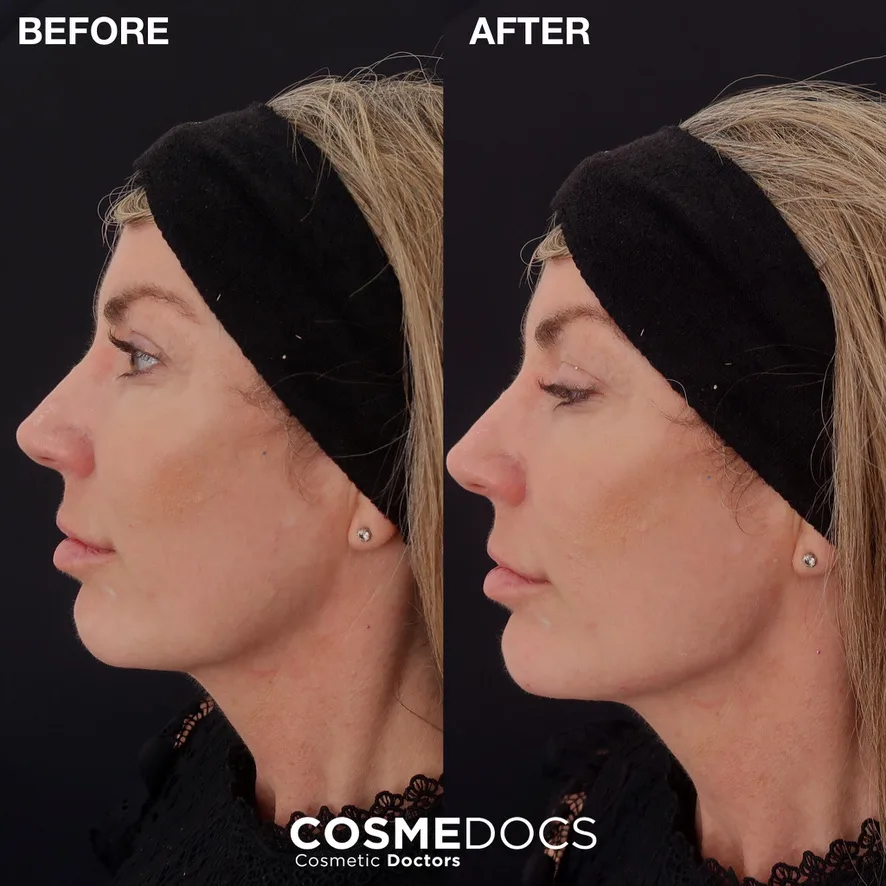 Female patient profile in her 30s — before and after 1ml of dermal filler per side at Cosmedocs, restoring the mandibular jaw angle from a softened 'I' shape back to a defined 'L' shape