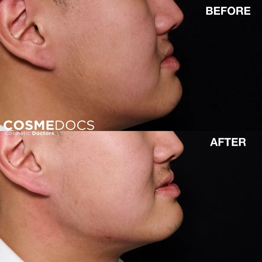 Male patient profile — before and after volume restoration at Cosmedocs, demonstrating reduction of lower-face heaviness and improved chin and jawline definition