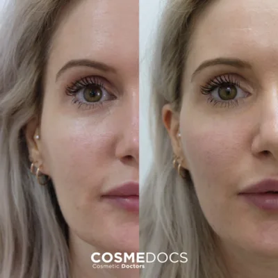 Cheek filler before and after — 1ml Swiss Teoxane Ultradeep, doctor-led at Cosmedocs Harley Street