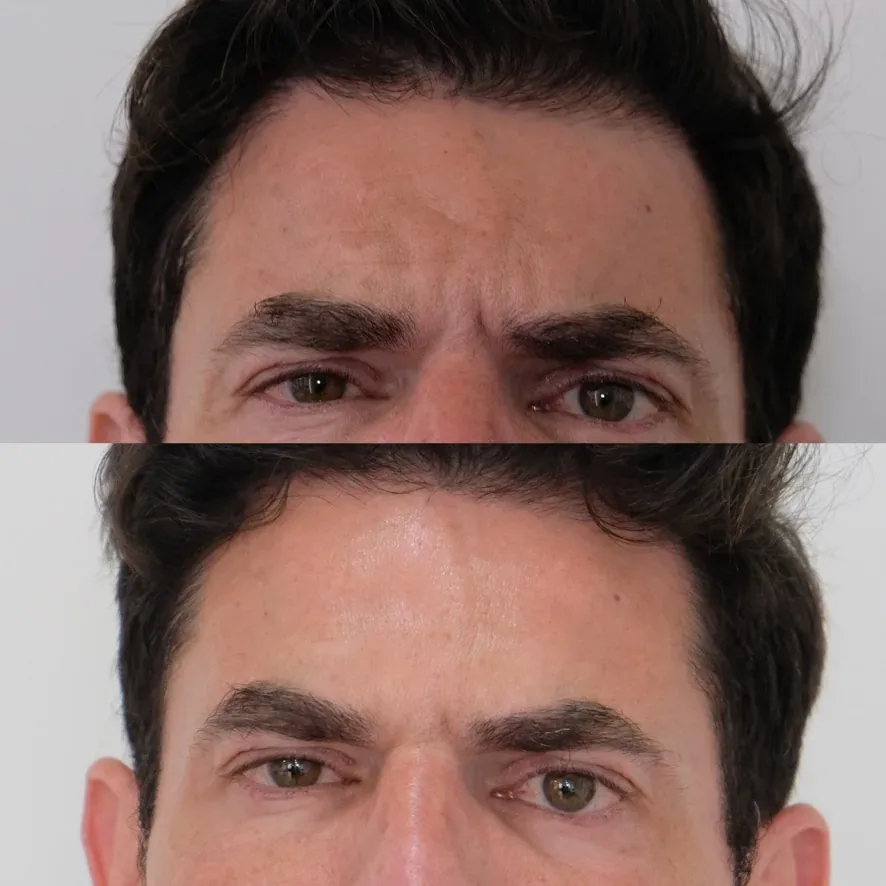 Botox ryppyjuonteet – ennen ja jälkeen – Cosmedocs