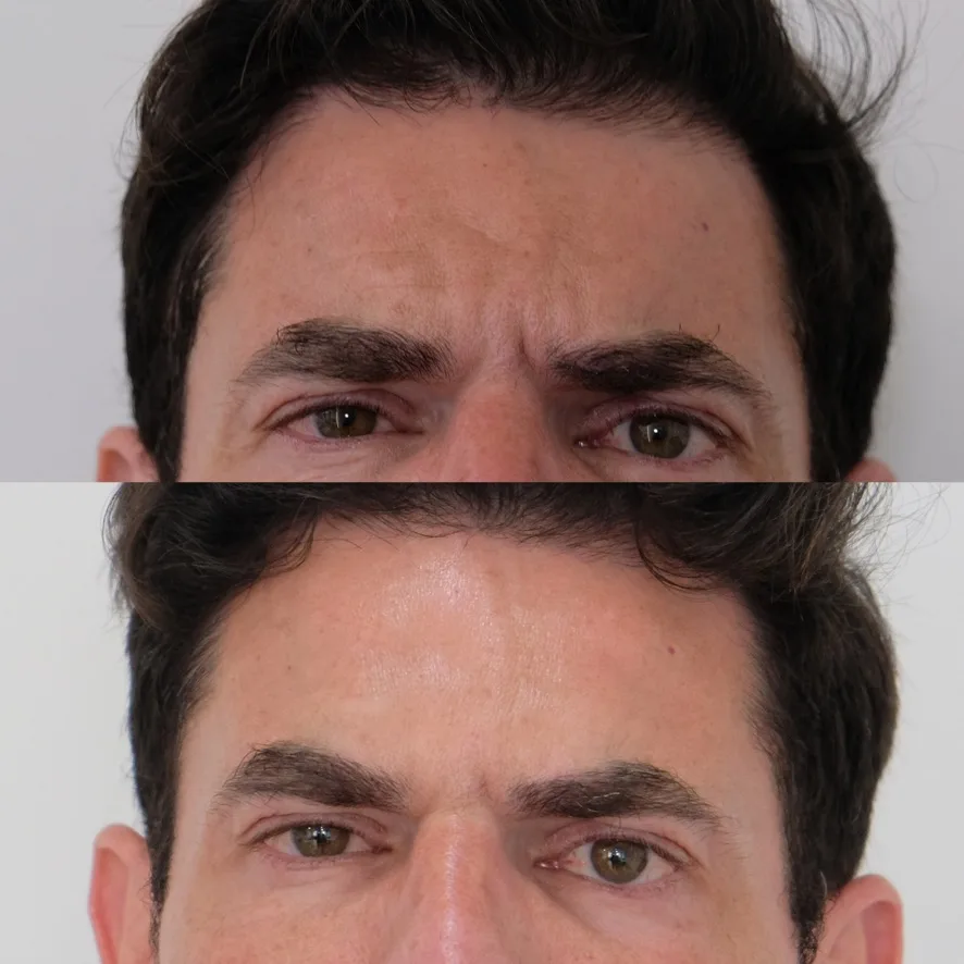 بوتوكس خطوط العبوس – قبل وبعد – Cosmedocs لندن