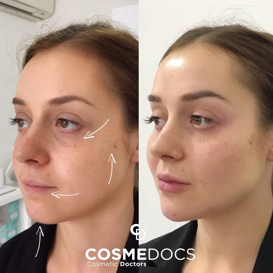 Natural facial rejuvenation showing subtle volume restoration — patient appears refreshed without visible signs of treatment