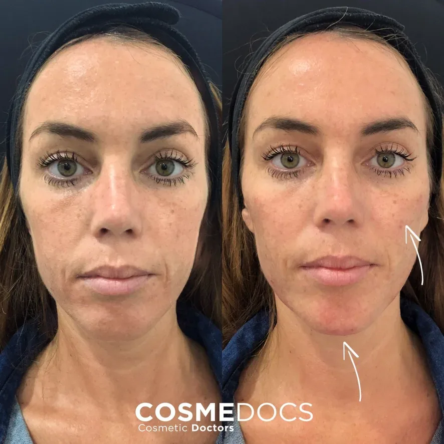 Leukahoito – ennen ja jälkeen – Cosmedocs