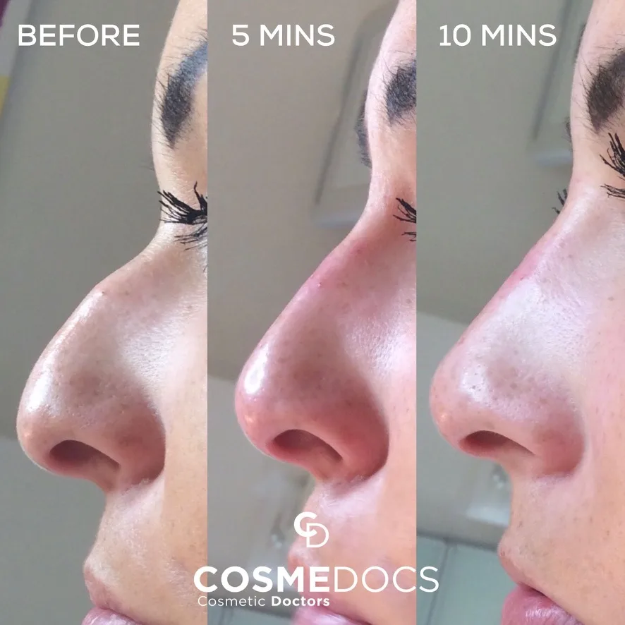 تجميل الأنف بدون جراحة – مراحل العلاج – Cosmedocs