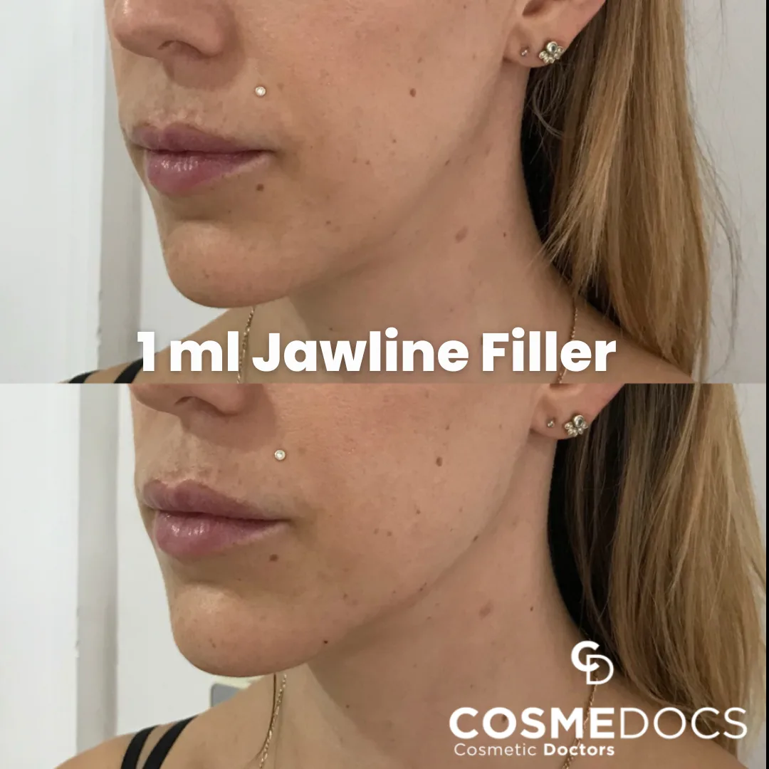 Before and after 1ml jawline filler showing subtle structural improvement to the mandibular border without width distortion