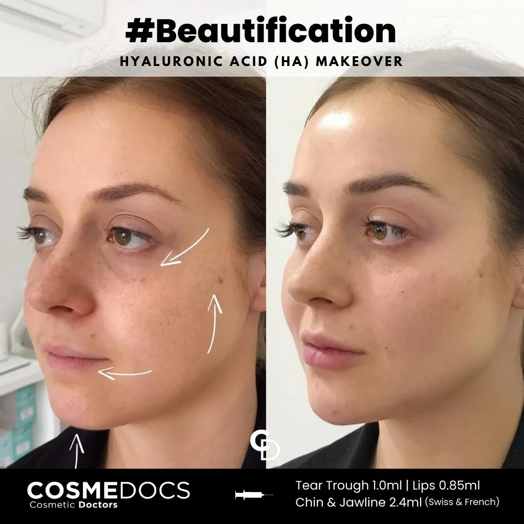 Hyaluronic acid makeover including chin, jawline, lips and tear trough showing comprehensive facial balancing