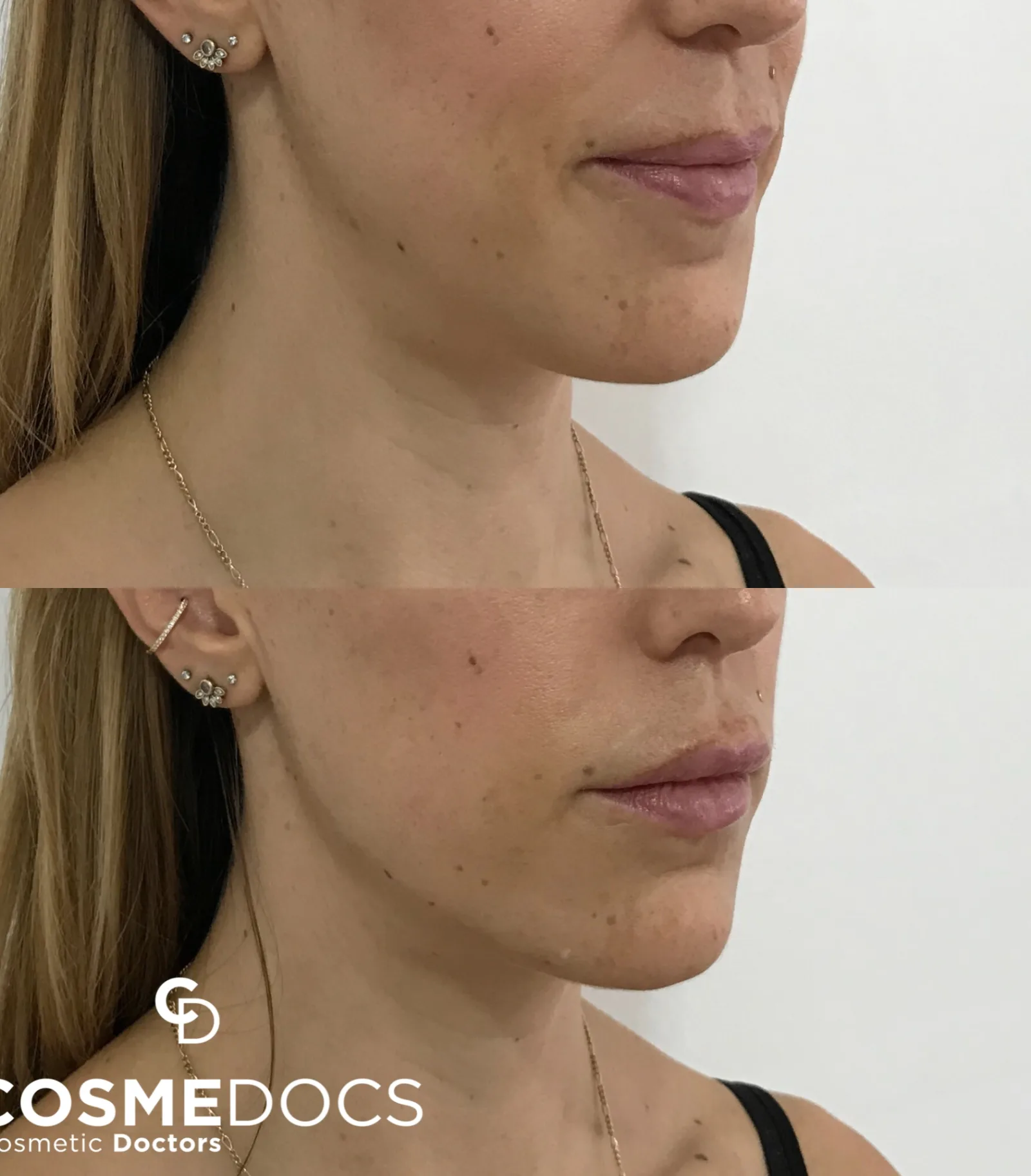 Before and after jawline filler showing subtle feminine contour improvement along the mandibular border
