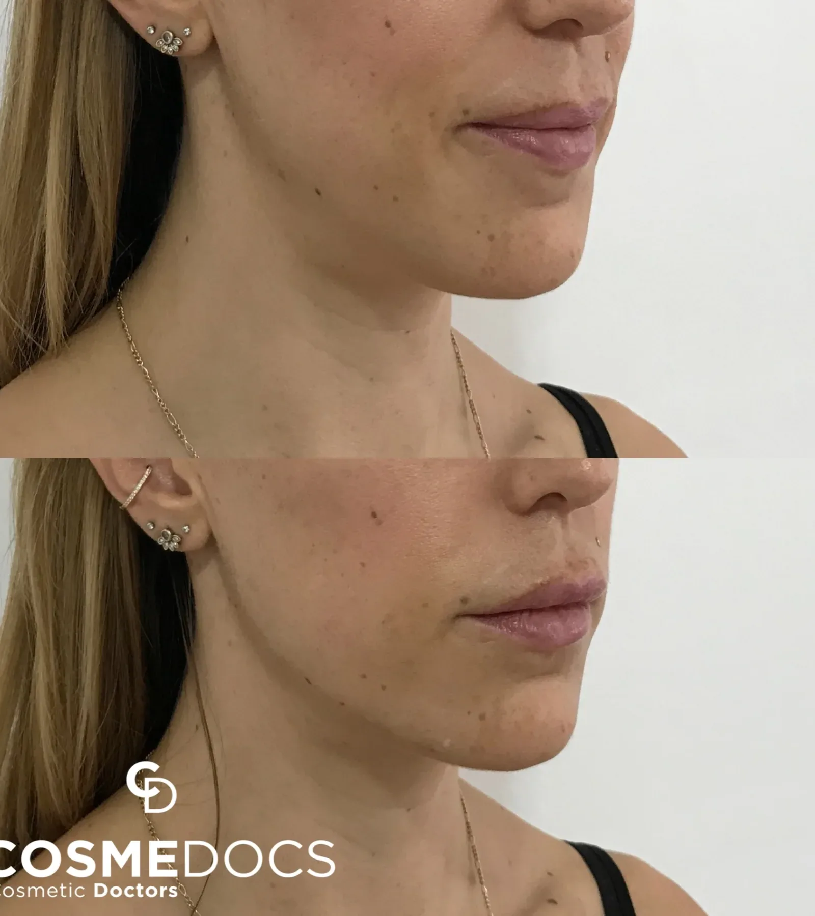 Before and after jawline filler showing subtle feminine contour improvement along the mandibular border