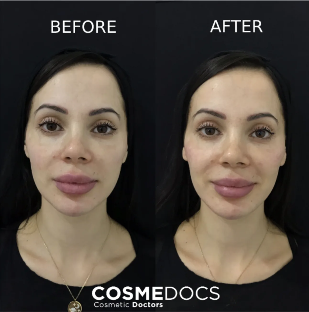 Frontal before and after jawline filler showing balanced lower face improvement with natural symmetry