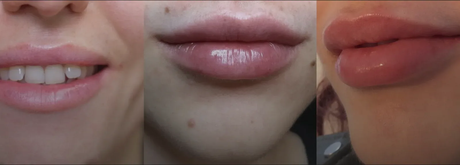 Three stages of lip filler showing natural lip, subtly enhanced lip with border definition, and full enhancement preserving natural shape