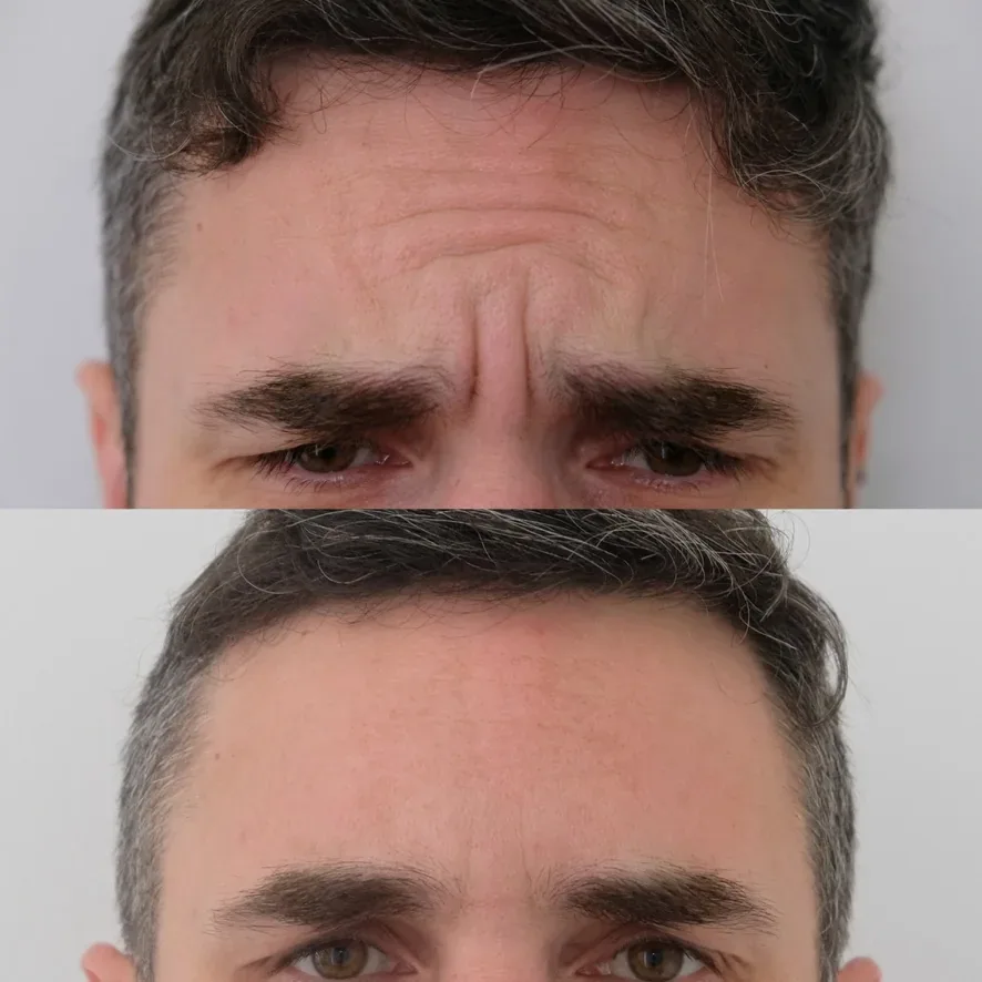 BroTox before and after, Cosmedocs