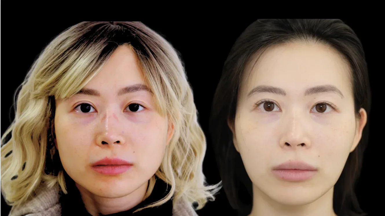 面部平衡改善 – 前后对比 – Cosmedocs 伦敦