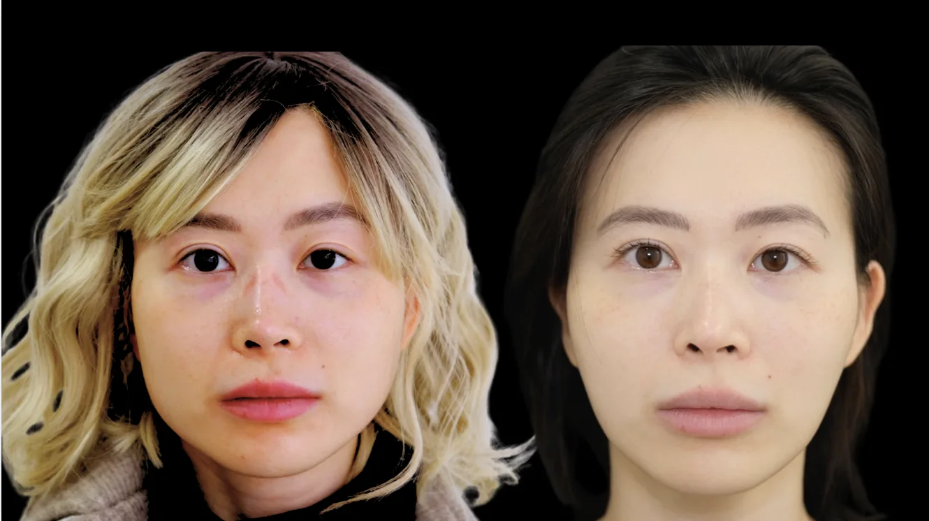 面部平衡改善 – 前后对比 – Cosmedocs 伦敦