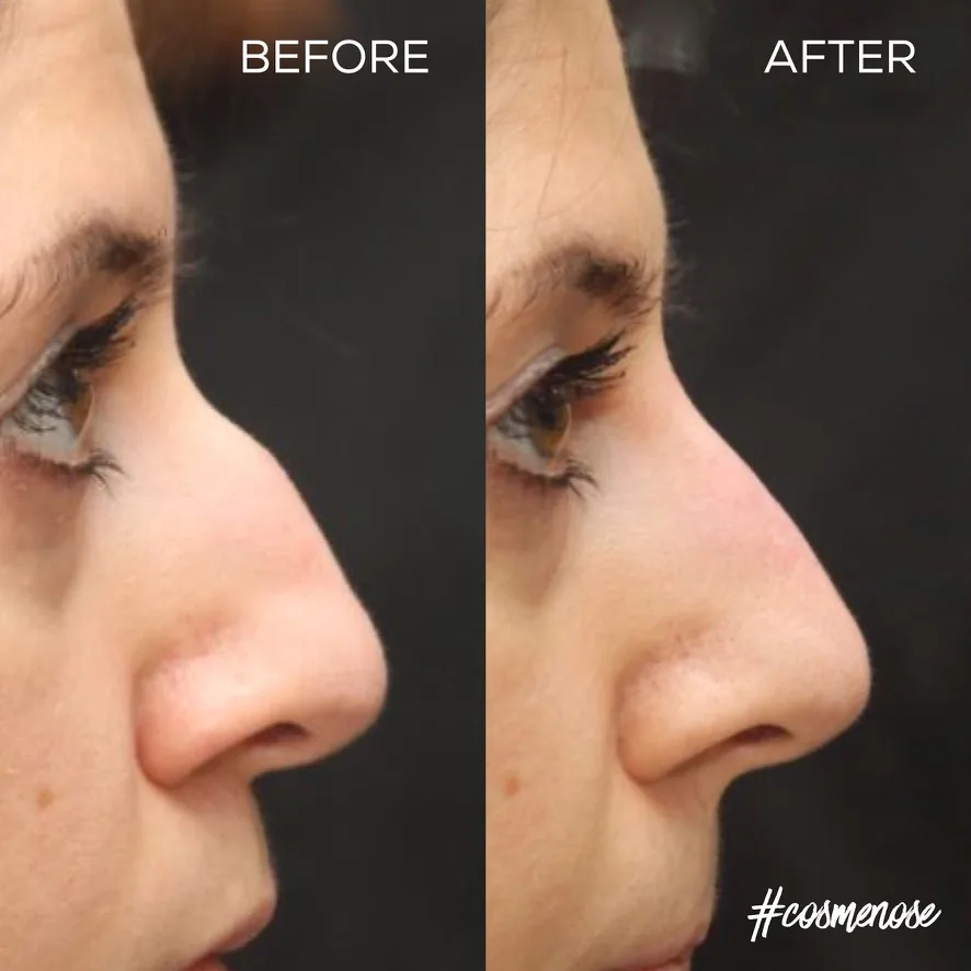 非手术鼻整形 – 前后对比 – Cosmedocs