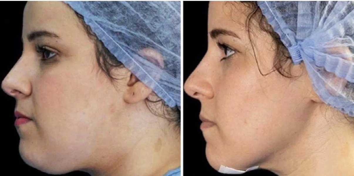 Before and after Endolaser Laser Fibre Lift — jawline and neck tightening, Cosmedocs Harley Street