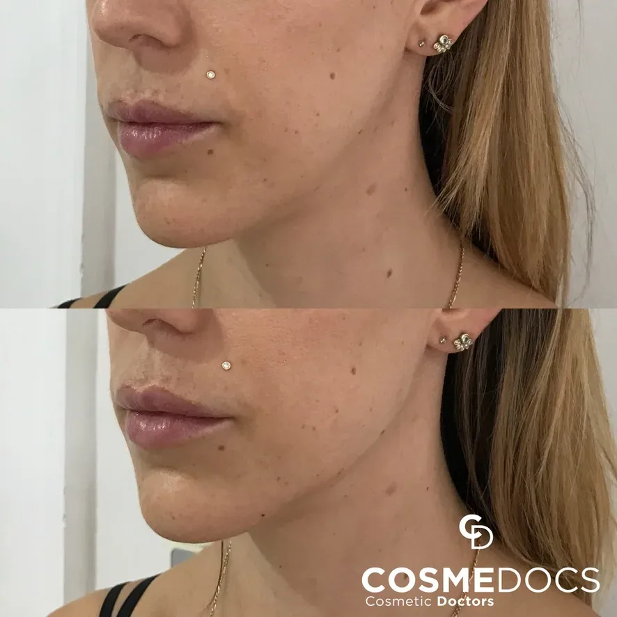 Mild jowls and loss of jawline definition restored with liquid face lift using dermal fillers and PDO thread