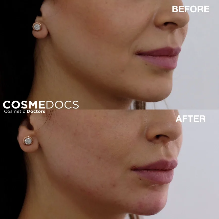Mild lift and definition of the jawline with non-surgical treatment