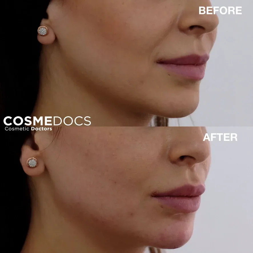 Mild lift and definition of the jawline with non-surgical treatment