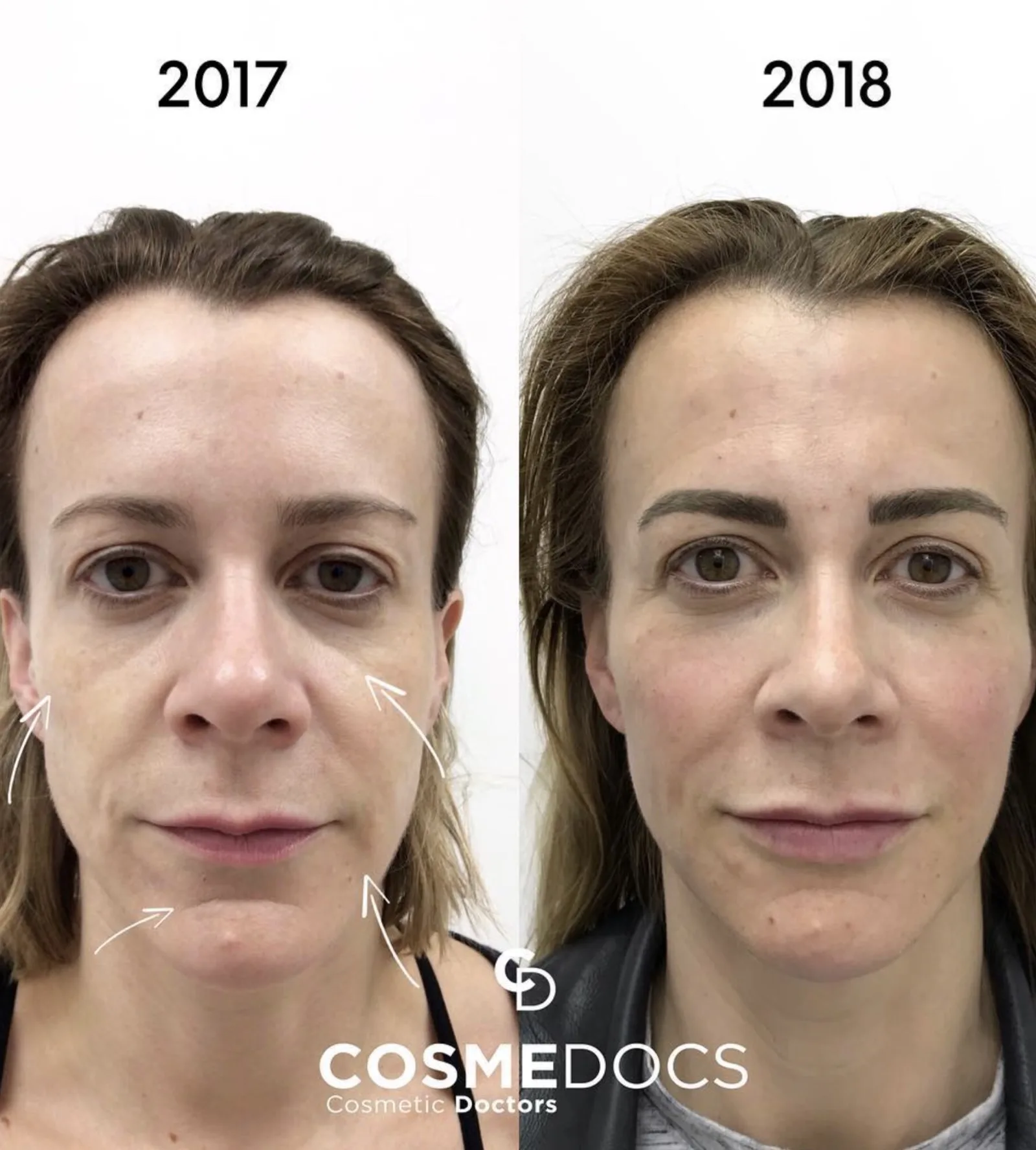 Before and after tear trough filler showing 2017 to 2018 transformation with reduced under-eye hollows