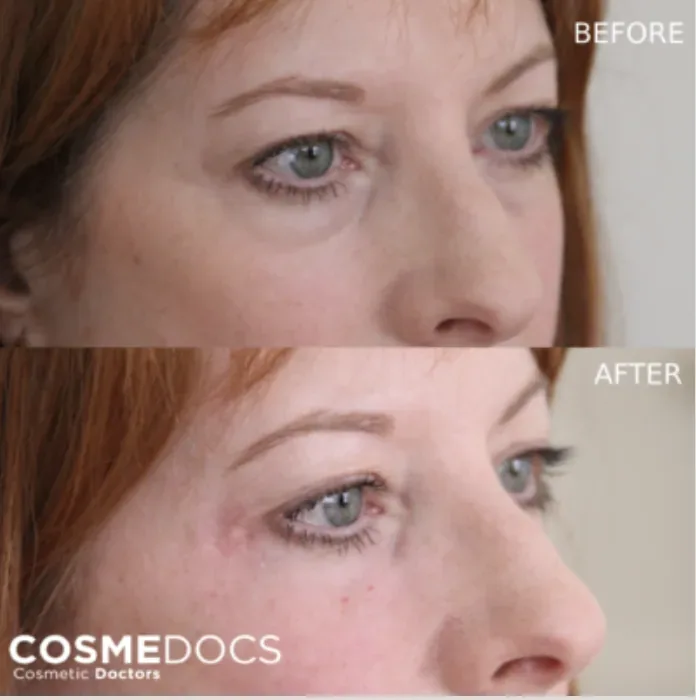 Before and after tear trough filler showing profile view of under-eye hollowing improvement