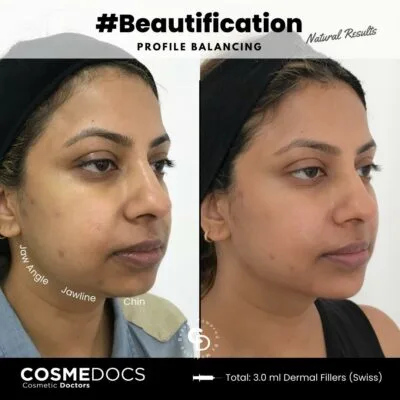 Before and after jawline filler showing enhanced lower face definition