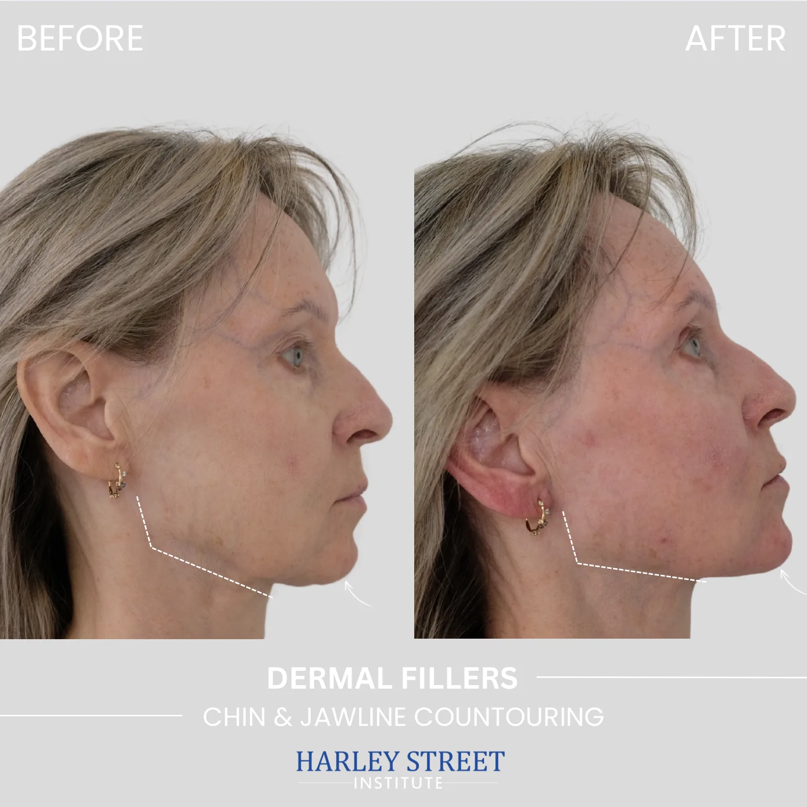 Chin & Jawline Contouring - Before and After comparison