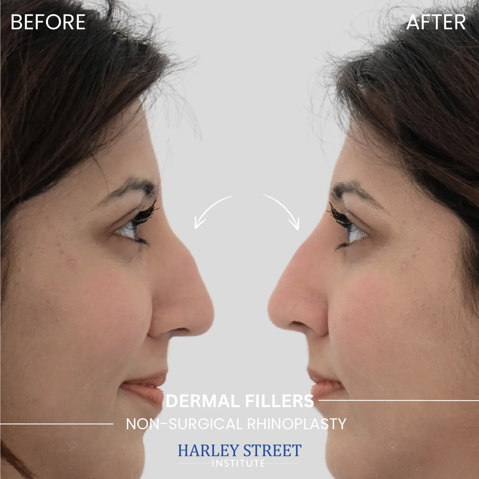 Non‑surgical Rhinoplasty - Before and After comparison
