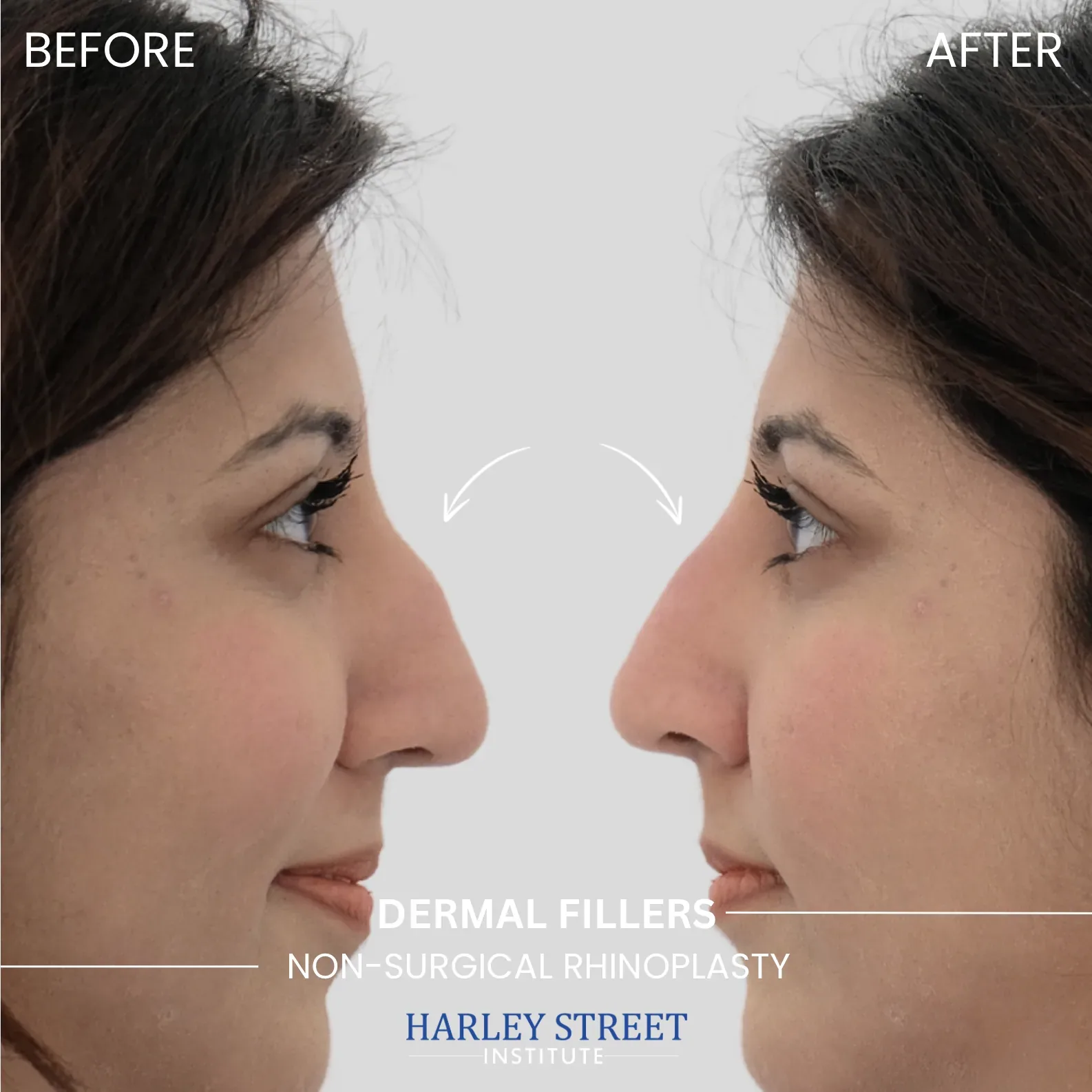 Non‑surgical Rhinoplasty - Before and After comparison