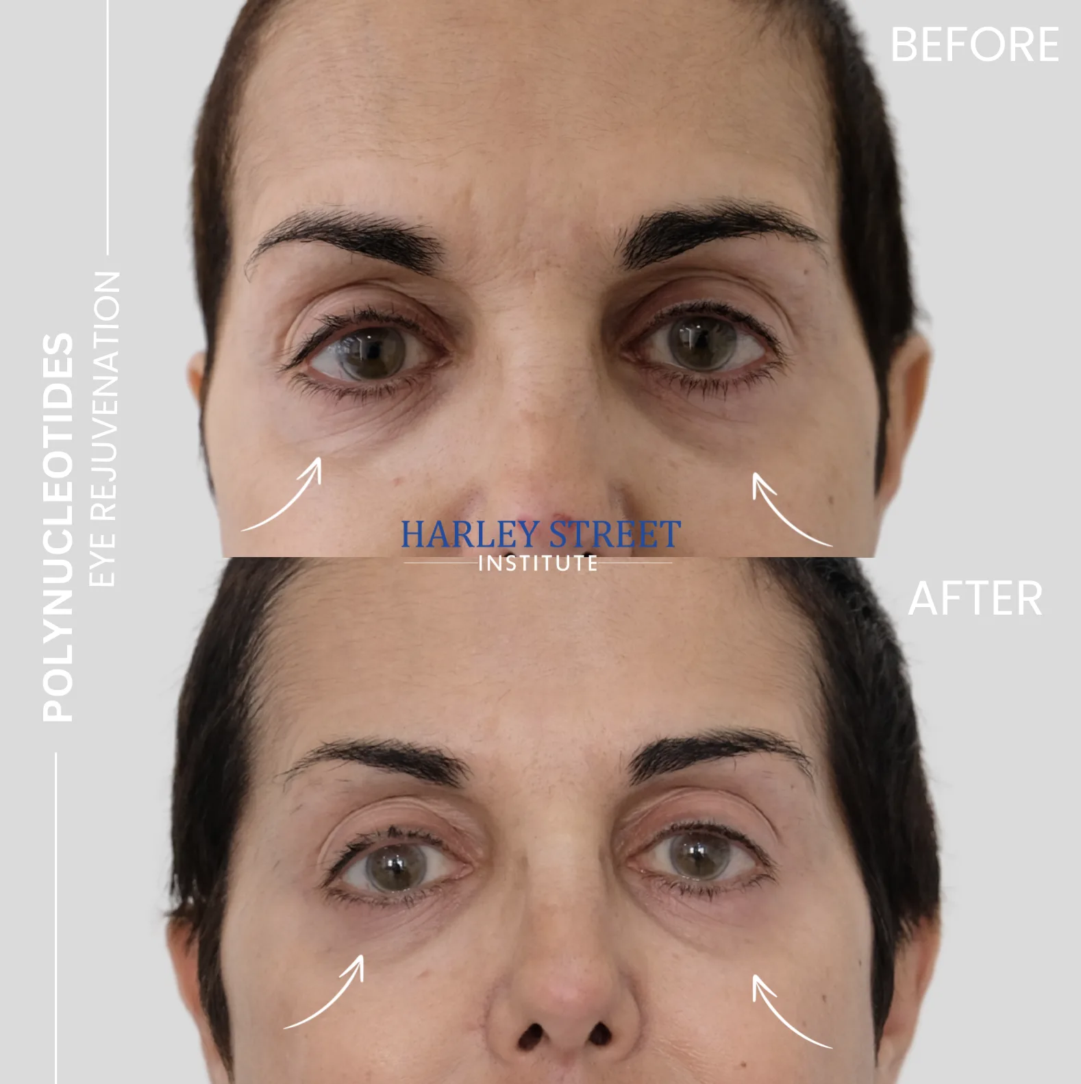 Polynucleotide Eye Rejuvenation - Before and After comparison