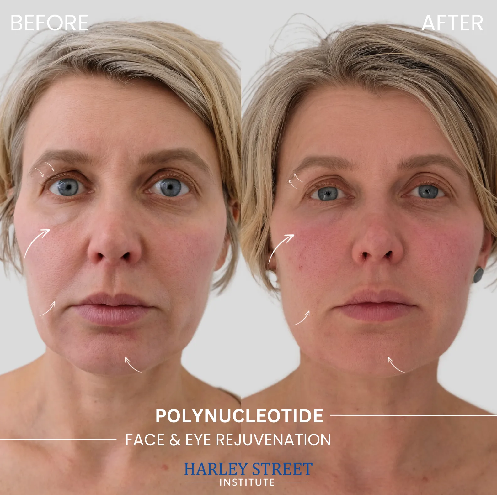 Polynucleotide Face & Eye Rejuvenation - Before and After comparison