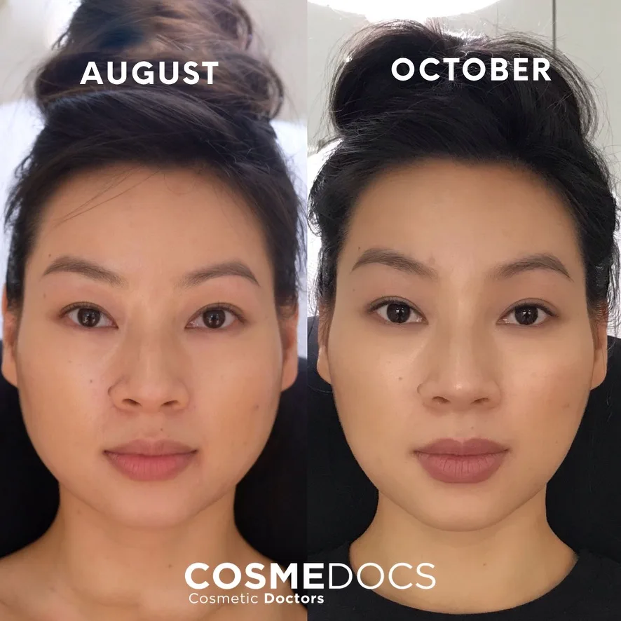 نتائج تجديد الوجه الكامل – قبل وبعد – Cosmedocs لندن