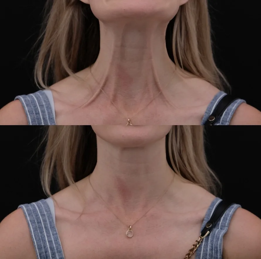 Nefertiti Lift before and after — visible reduction in the strength of vertical platysmal cords and a softer neck-décolletage junction
