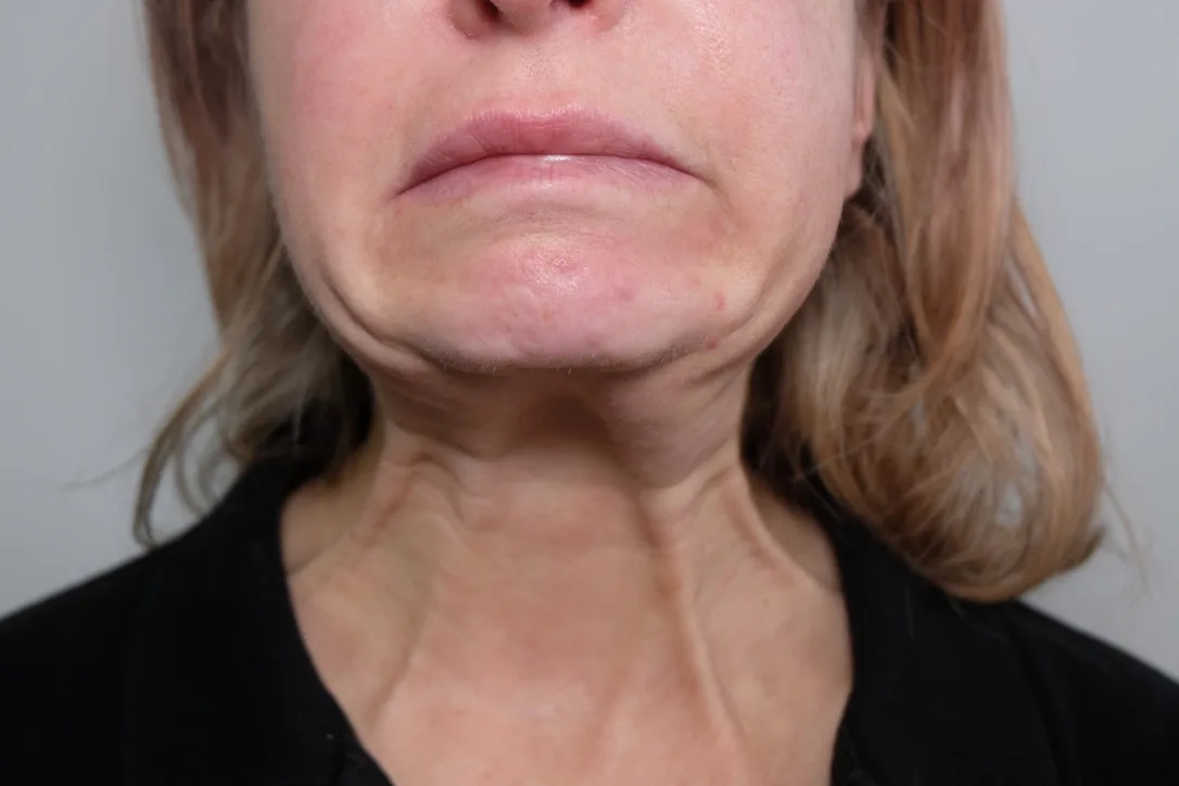 Clinical example of very strong vertical platysmal cords (bands) standing out on the anterior neck of a female patient — a textbook indication for the Nefertiti Lift