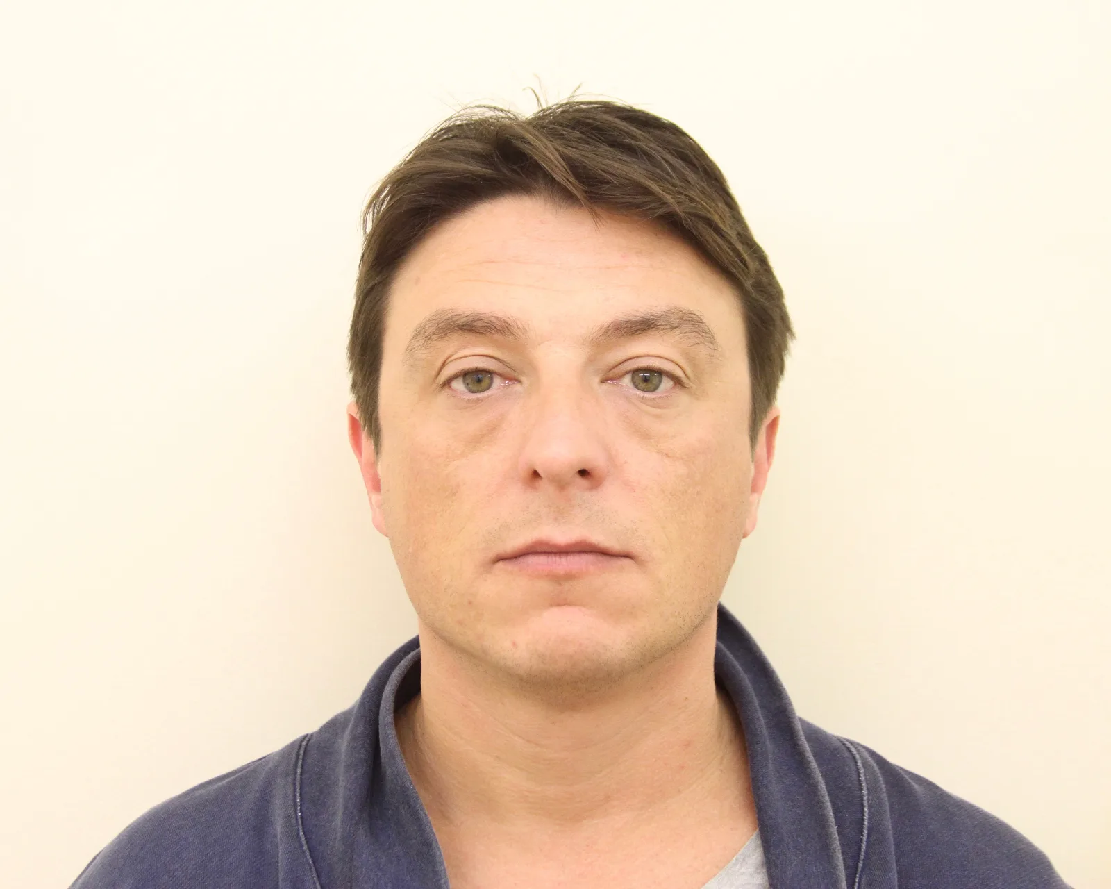Same male patient one year after a third masseter Botox treatment at Cosmedocs — maintained slimmer jaw and refined lower face