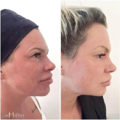 Natural lifting and tightening results with PDO cog threads