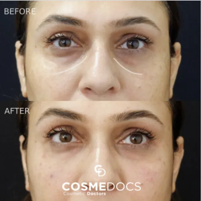 Before and after tear trough filler showing under-eye rejuvenation and hollow correction