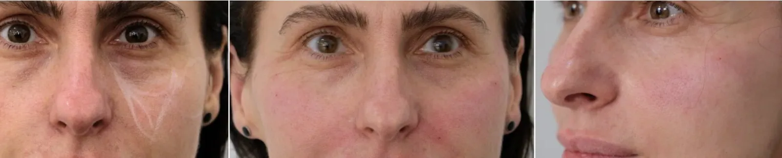 Real patient under-eye assessment trio — front, frontal close-up, and three-quarter view — tear trough filler consultation at Cosmedocs Harley Street