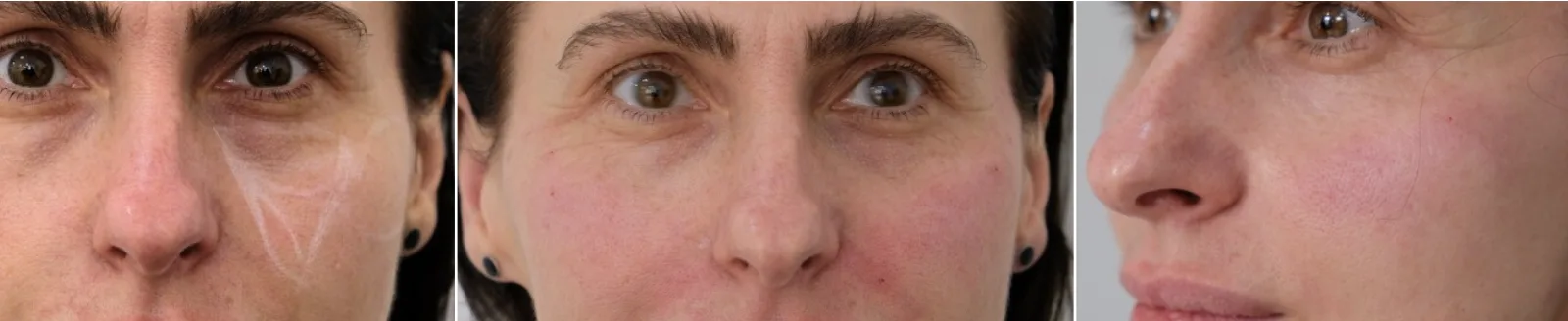Real patient under-eye assessment trio — front, frontal close-up, and three-quarter view — tear trough filler consultation at Cosmedocs Harley Street