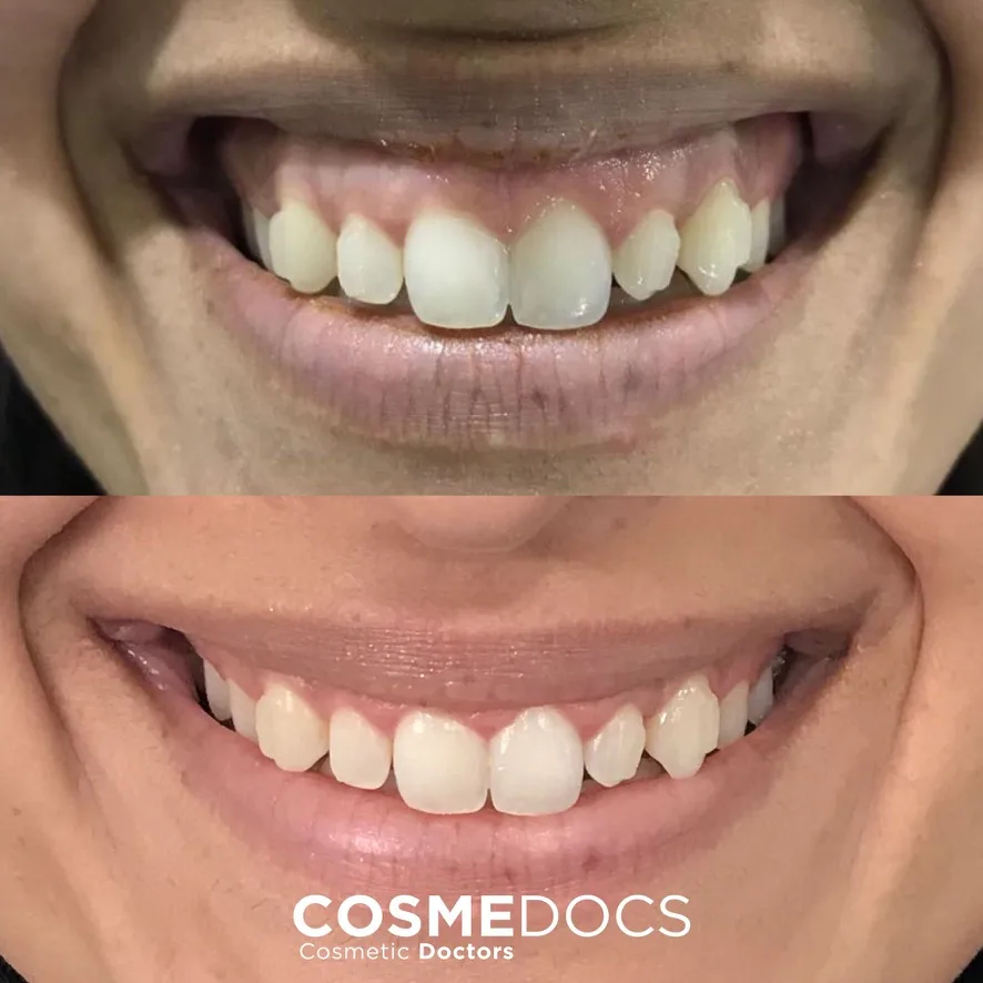 Gummy smile before and after Botox showing reduced gum visibility