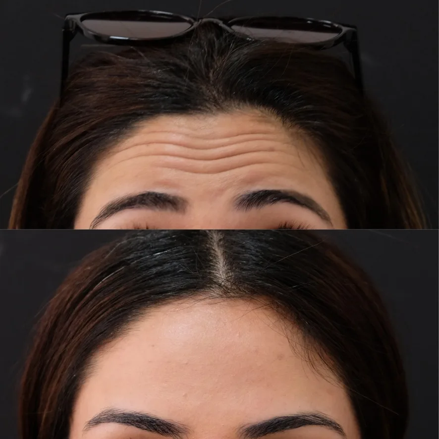 Botox before and after showing natural softening of facial tension