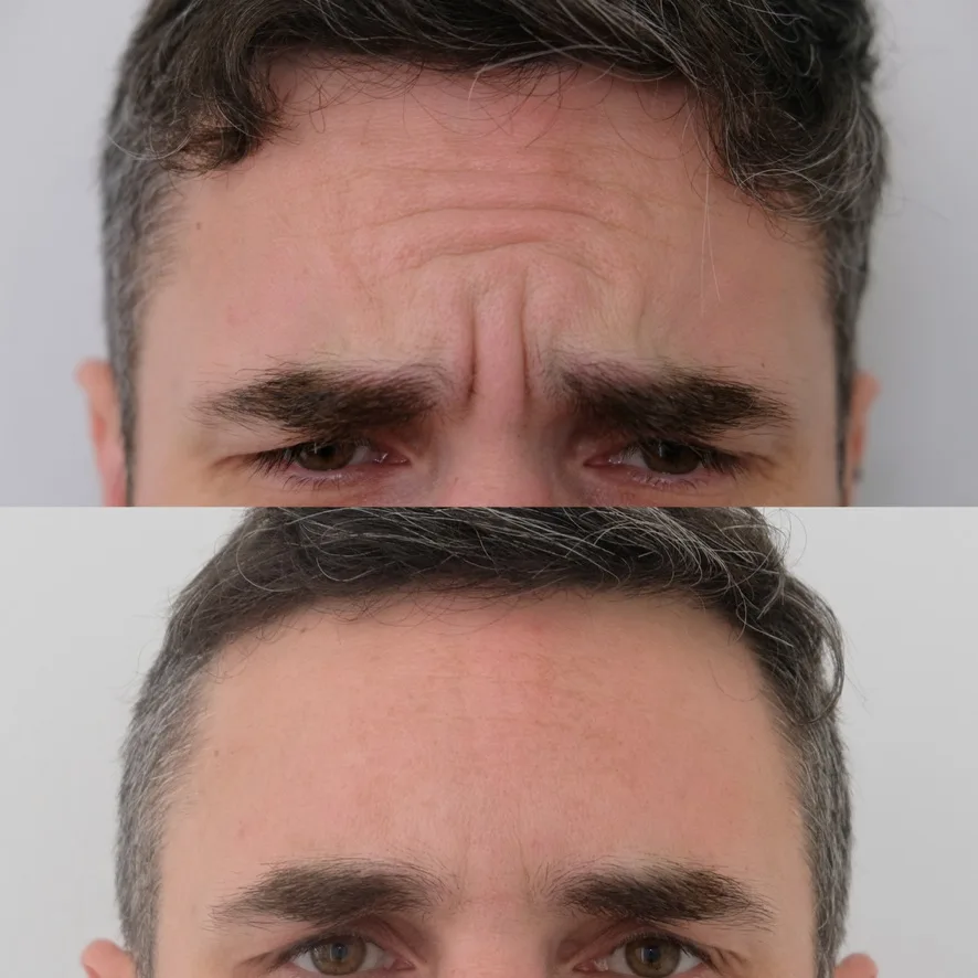 Before and after Botox demonstrating subtle reduction in muscle activity