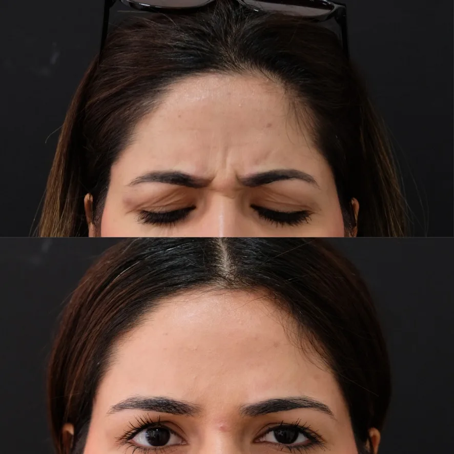 Before and after Botox showing softened facial tension