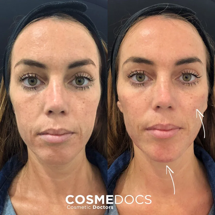 Chin filler before and after — jawline contour enhancement Before and after chin filler demonstrating enhanced jawline contour and chin projection at Cosmedocs