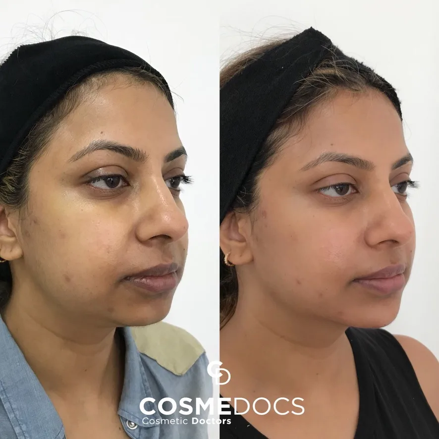 Chin filler before and after — click to view full gallery Before and after chin filler showing profile harmonisation and improved chin shape at CosmeDocs Harley Street