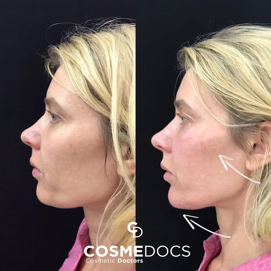Chin filler before and after — profile projection Before and after chin filler demonstrating improved profile projection and jawline definition