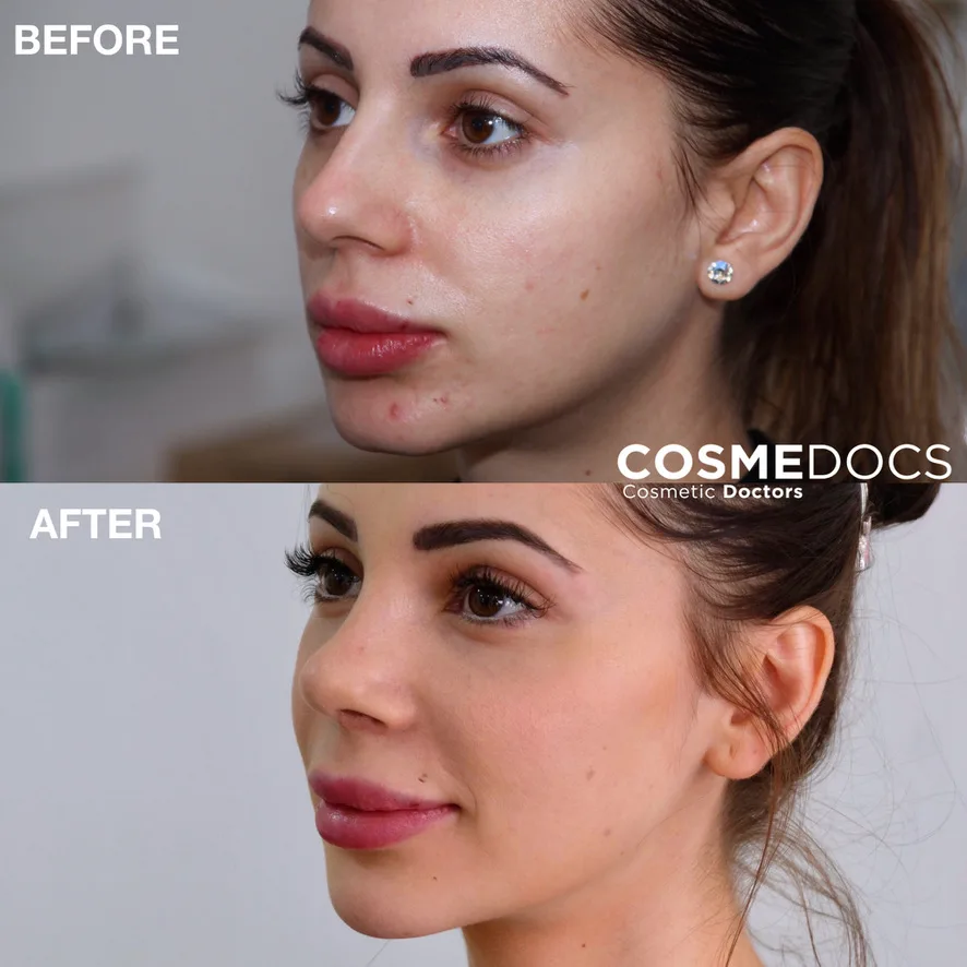 Chin filler before and after — chin contouring Before and after chin filler showing chin contouring and lower face balance at Cosmedocs London
