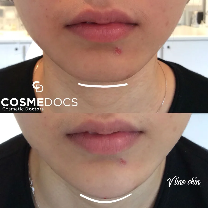 Chin filler before and after — V-line enhancement Before and after chin filler showing V-line chin enhancement and projection at Harley Street