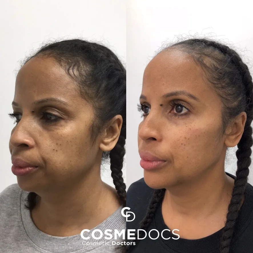 Chin filler before and after — facial rejuvenation Before and after chin filler demonstrating facial rejuvenation and chin augmentation at Cosmedocs