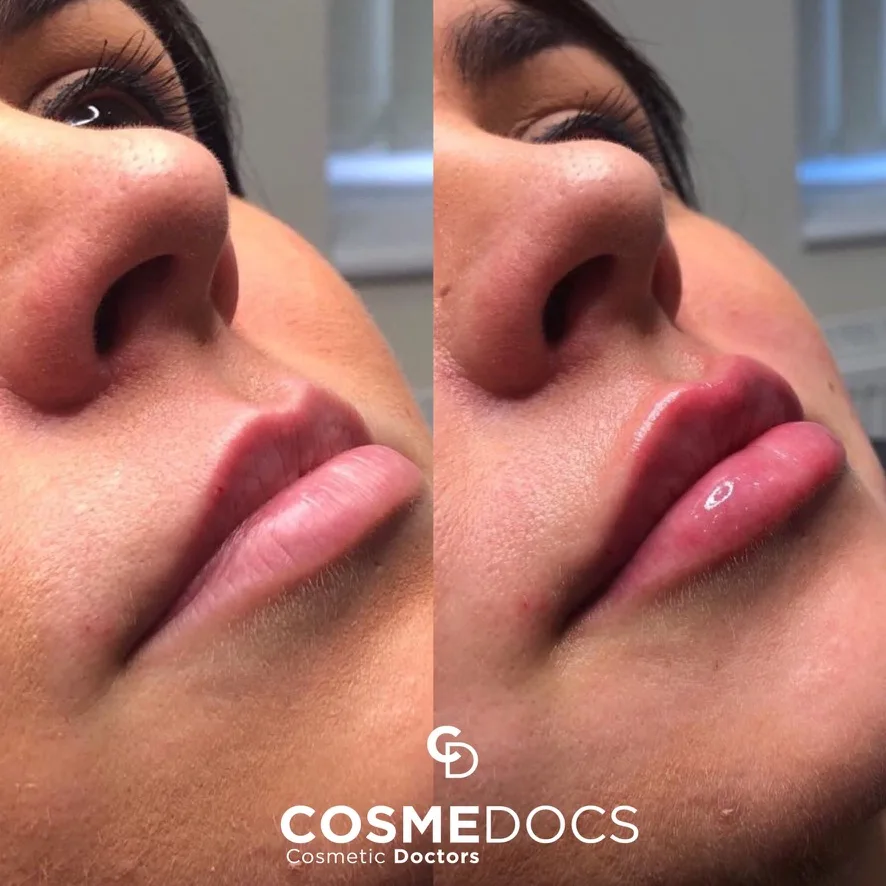 Lip augmentation before and after profile view showing natural volume enhancement